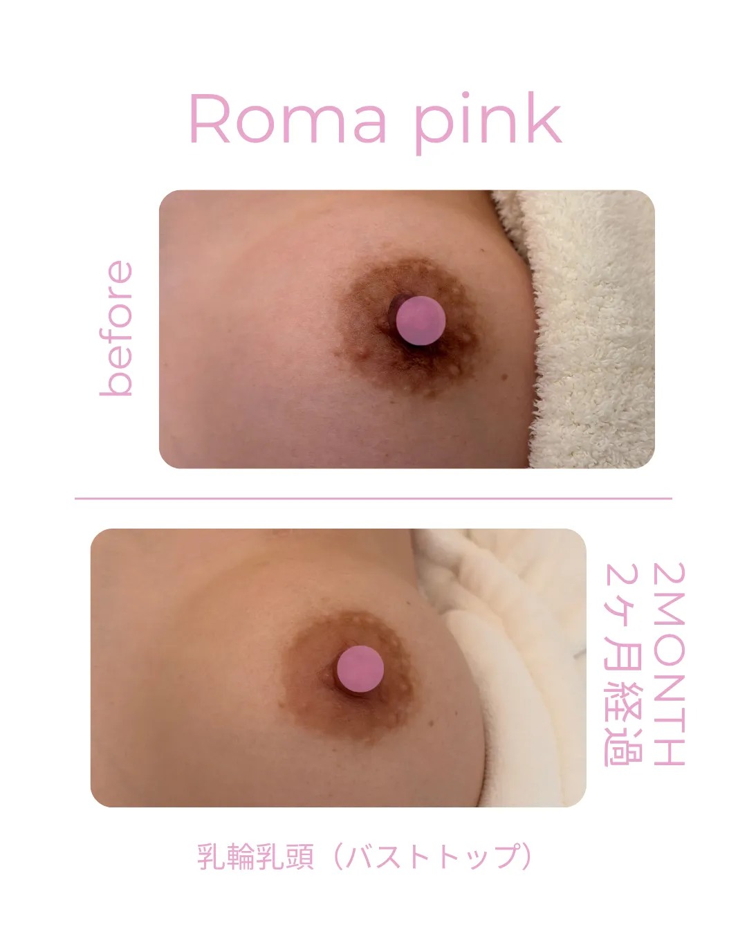 ローマピンク/乳輪乳頭(バストトップ)モニターS様・2ヵ月経過